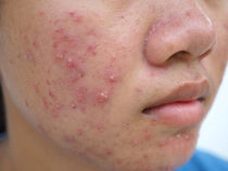 Improving Acne Through Diet and Lifestyle: Strategies for Adults and Teens