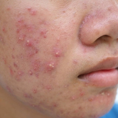 Improving Acne Through Diet and Lifestyle: Strategies for Adults and Teens