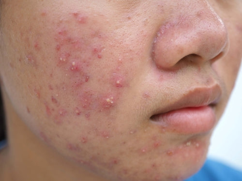 Improving Acne Through Diet and Lifestyle: Strategies for Adults and Teens